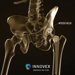 Innovex #FossilFueled Fossil Fueled Hip Replacement